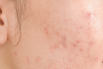 Piel sensible farmacia romany
