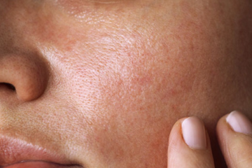 piel grasa farmacia romany